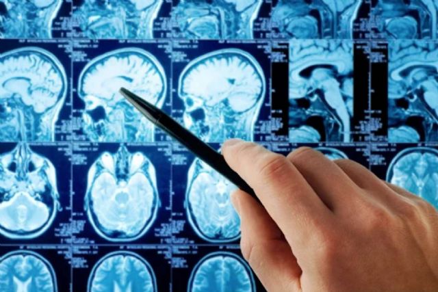 Beneficios de oncothermia en tumor cerebral (Gliomas) - 1, Foto 1