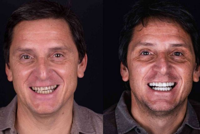 Carillas estéticas, revolución en el cuidado dental para conseguir una sonrisa estilo Hollywood - 1, Foto 1
