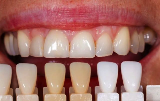 El 40% de la población se acompleja de su sonrisa por no poder blanquearse los dientes - 1, Foto 1