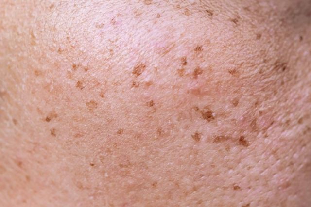 Léntigos solares, tratamiento con láser en Madrid por el Centro Médico El Pilar - 1, Foto 1