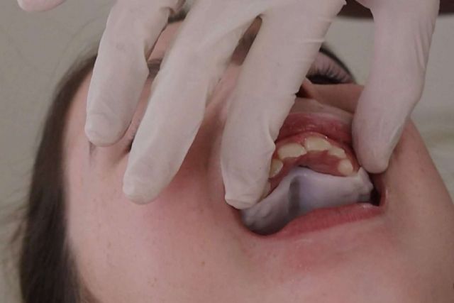 Smart Aligner Services, precursor en Europa del primer evento sobre Invisalign Palatal Expander - 1, Foto 1