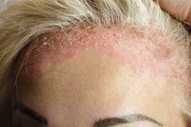 Qué es la foliculitis; causas, factores y prevención para el invierno - 1, Foto 1