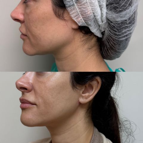 El Microlifting o lifting de fin de semana llega a España de la mano del Dr. Albert Bosch - 1, Foto 1