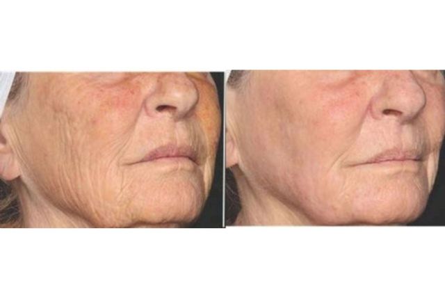 Clínica Dermatológica Internacional incorpora el láser frío regenerativo que combate los signos de la edad - 1, Foto 1