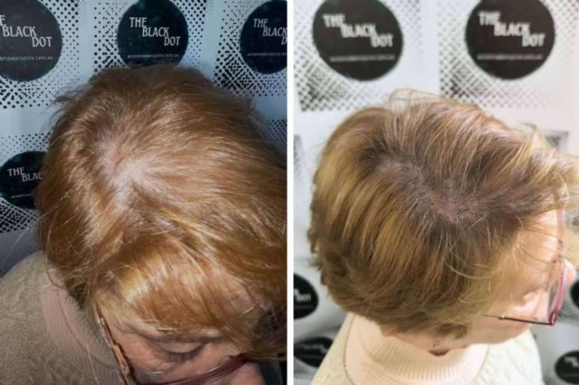 Mejorar la confianza con la Micropigmentación Capilar; Descubrir The Black Dot en Murcia - 1, Foto 1