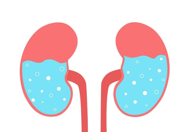 Cómo la hidronefrosis puede afectar la salud renal de los niños - 1, Foto 1