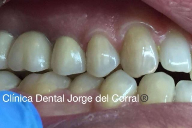 Prótesis fija estética de zirconio; la apuesta de Clínica Dental Jorge del Corral por la calidad y la estética dental - 1, Foto 1