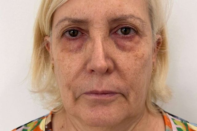 SEFFILLER®? llega a MD Cliniques; regeneración cutánea con tejido graso propio - 1, Foto 1