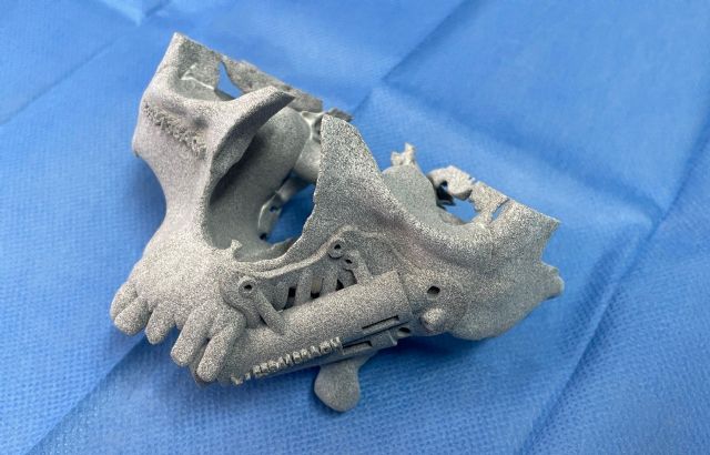 Los implantes cigomáticos mediante cirugía guiada son una solución segura para la rehabilitación de maxilares atróficos o secuelas de tumores - 1, Foto 1