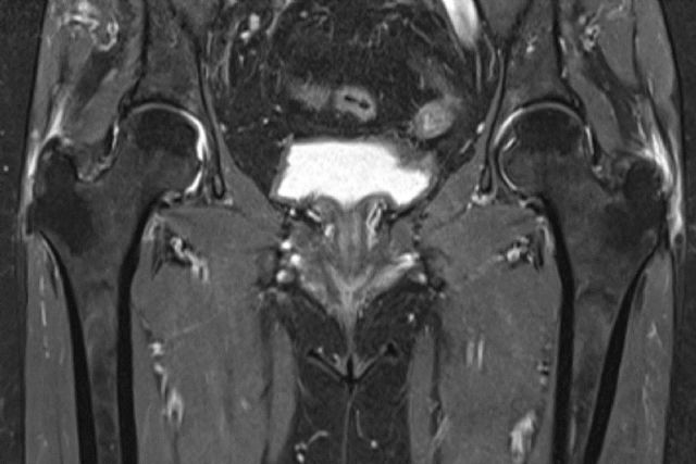 ¿Se siente un dolor persistente en la parte lateral de la cadera? - 1, Foto 1