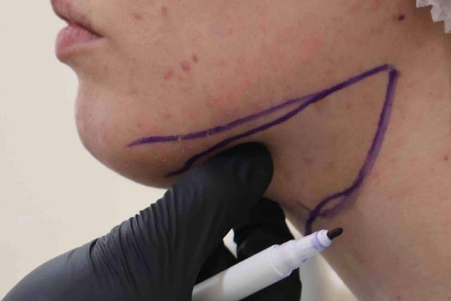 ¿Cuál es el mejor tratamiento para eliminar la papada sin cirugía en Málaga? - 1, Foto 1