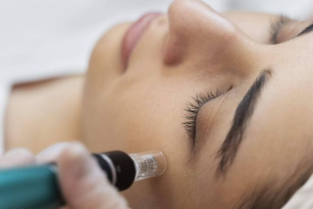 El tratamiento con ´Dermapen´ se consolida como tendencia en el cuidado estético de la piel - 1, Foto 1