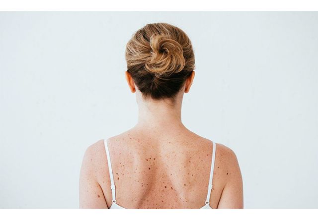 ¿Por qué el láser de picosegundos es el mejor para eliminar el pigmento (así como la tecnología más versátil)? - 1, Foto 1