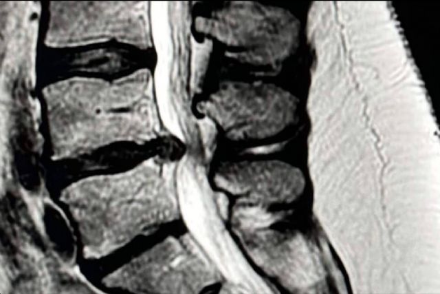 Entrevista al Dr. Botella-Asunción; Microdiscectomía vs. Discectomía endoscópica en la hernia discal lumbar - 1, Foto 1
