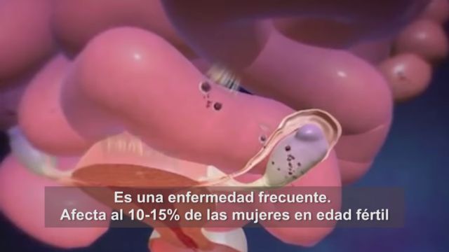 Más de 10.000 euros recaudados para estudiar la endometriosis - 1, Foto 1