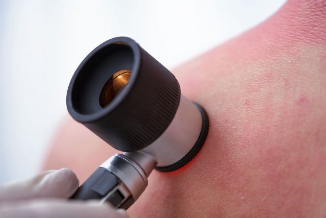 La Dermatitis Atópica es la segunda causa más frecuente de visita al dermatólogo - 2, Foto 2