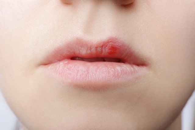 Herpes labial: siete de cada diez españoles podrían desarrollarlo - 1, Foto 1