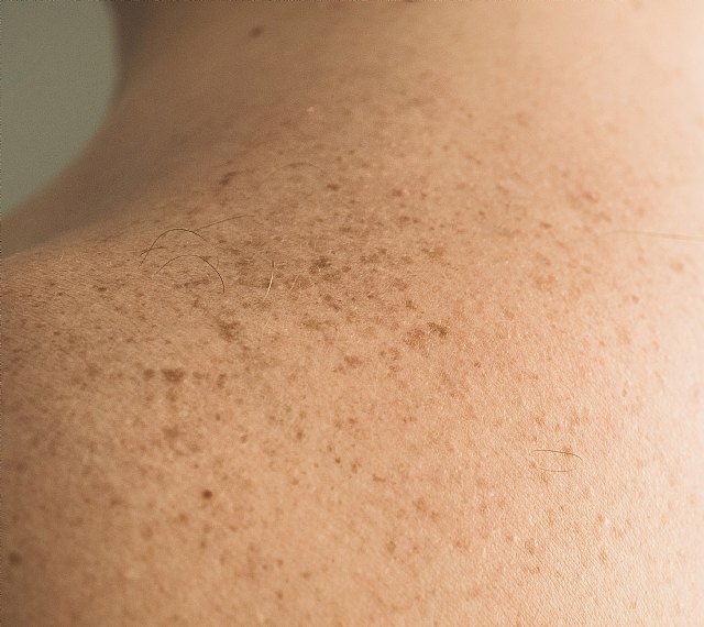 Manchas en la piel, un riesgo durante 365 días al año - 1, Foto 1