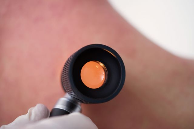 El 25% de los casos de dermatitis atópica persisten durante la adolescencia - 1, Foto 1