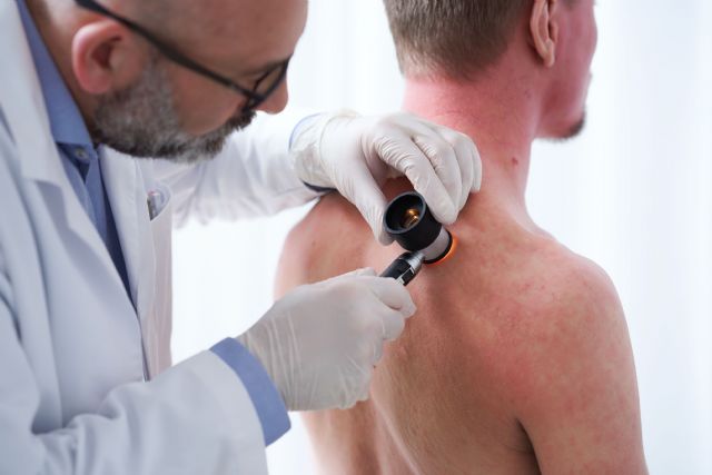 El 25% de los casos de dermatitis atópica persisten durante la adolescencia - 2, Foto 2