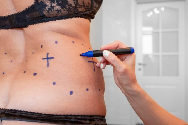 Aumenta un 25% la demanda de liposucciones y balones gástricos - 1, Foto 1