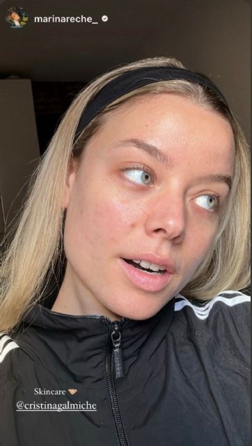 La generación Z pierde el miedo a enfrentarse al acné - 4, Foto 4