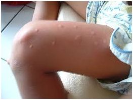 Una plaga de mosquito tigre provoca múltiples atenciones médicas en la pedanía de Puente Tocinos - 2, Foto 2
