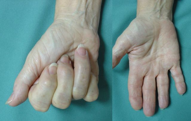 Alrededor del 8% de la población adulta en España –casi 4 millones- padece artrosis en una o ambas manos - 2, Foto 2