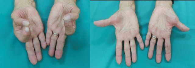 Alrededor del 8% de la población adulta en España –casi 4 millones- padece artrosis en una o ambas manos - 3, Foto 3