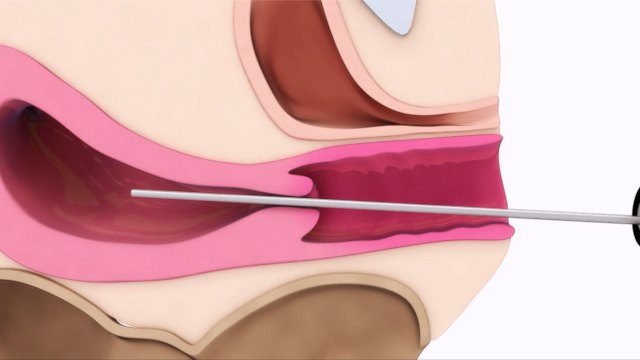 Las intervenciones ginecológicas a ciegas ponen en peligro la salud de la mujer - 1, Foto 1