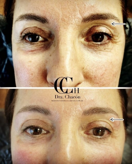 Relleno de cuenca orbitaria con ácido hialurónico para rejuvenecer la mirada: en qué consiste este novedoso tratamiento en España - 1, Foto 1