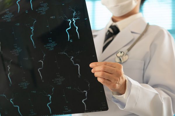 Cómo prevenir y afrontar un ictus - 1, Foto 1