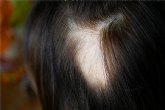 Alopecia femenina: un problema silencioso pero cada vez ms frecuente