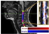 Un nuevo mtodo para medir la atrofia de la mdula espinal se incorpora a un ensayo sobre la esclerosis mltiple