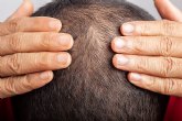 �Estamos ante una nueva generaci�n de tratamientos contra la alopecia?