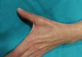 El síndrome del túnel carpiano y otros nervios de la mano, se ven severamente agravados por la COVID-19