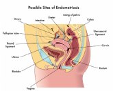 Día mundial de la endometriosis