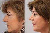 Qu� hacer antes de pasar por una rinoplastia ultras�nica, por el Dr. P�rez Villar