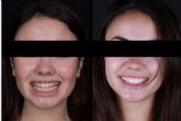 ?Cu�les son las ventajas de las carillas dentales?, por los profesionales de Carillas WikendR