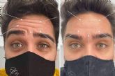 El b�tox, el tratamiento perfecto para reducir las arrugas de la frente, entrecejo y patas de gallo