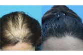 Trasplante capilar para mujeres que sufren alopecia femenina, por la clnica Innovacin Capilar