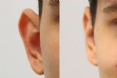La cirug�a de orejas, ?Qu� se debe saber?
