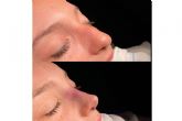 Los diferentes tipos de rinoplastia y los aspectos m�s importantes a la hora de elegir, de la mano del Dr. �lvaro P�rez-Villar