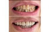 Todo lo que se debe saber acerca de las microcarillas dentales, por Cl�nica MG Dental & Est�tica Facial