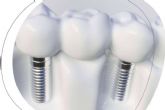 La Cl�nica Dental Agudo Rosa de Albacete es especialista en implantes dentales