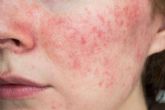 Los tratamientos efectivos para la ros�cea, por la Cl�nica Dermatol�gica De Felipe