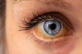 ?A qu se deben los ojos amarillos y dnde tratarlos?, el Instituto Oftalmolgico Dexeus lo explica