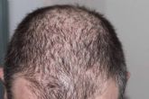 Contra la alopecia androgenética, la mesoterapia capilar con antiandrógenos se establece como un arma eficaz