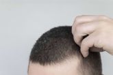 ?Es culpable la caspa de la cada del cabello?