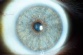 Los avances en las operaciones de cambio de color de ojos con lser, con Clnica Eyecos